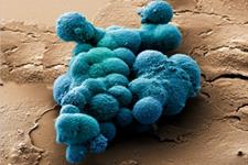 فقدان اکسیژن در سلول های سرطانی منجر به رشد و متاستازمی شود