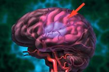 گامی به سوی درمان سکته مغزی بر پایه سلول های بنیادی