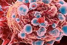 طراحی نوعی RNA  برای مقابله با سرطان