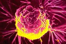 هدف قرار دادن سلول های بنیادی در سرطان سه گانه  سینه