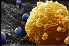 کدام نوع سرطان پروستات تهدید کننده حیات است؟