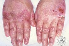 سلول های بنیادی مزایای طولانی مدتی را برای بیماری های پوستی انسان فراهم می کنند