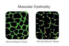 طرح تزریق سلول های بنیادی به بیماران دیستروفی عضلانی آغاز می شود