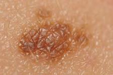جهشV60L خطر سرطان پوست را افزایش می دهد.