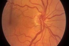 عدم تأثیرسلول های بنیادی بر درمان هیپوپلازی عصب بینایی در کودکان 