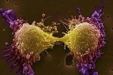 انواع متفاوت سلولی در سرطان پروستات 
