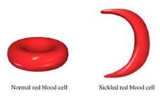 شناسایی پاشنه آشیل کم خونی داسی شکل با استفاده از مطالعات ویرایش ژن