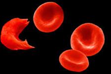 پیوند سلول های بنیادی برای معالجه بالغین مبتلا به کم خونی داسی شکل