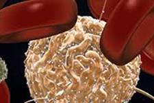 پیوند سلول های بنیادی خون ساز آلوژن برای بیماران مبتلا به لوکمیای میلوئید مزمن بعد از تیمار با مهارکننده های تیروزین کینازی