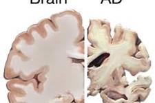 رسوب اسیدهای چرب در نزدیکی سلول های بنیادی مغز بیماران آلزایمری