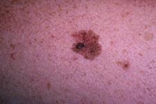 چگونه سلول های سرطان پوست متاستاز می کنند؟