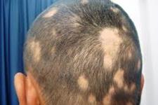 رشد مجدد مو در بیماران آلوپسی آره آتا به دنبال سلول درمانی