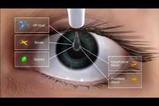 نانو دارو برای خشکی چشم، کمک رسانی با مشکلات کمتر