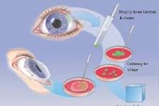 امیدواری برای درمان نابینایی ناشی از فقدان سلول های بنیادی لیمبال