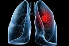 عامل پراکندگی سرطان ریه چیست؟