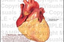 بهبود عملکرد قلبی بعد از تزریق سلول های بنیادی مشتق از چربی اطراف قلب 