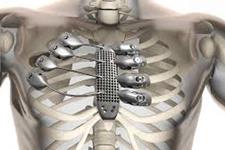 استفاده از دنده های پرینت شده سه بعدی برای بیماران سرطانی