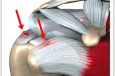 استفاده از سلول های بنیادی برای درمان آسیب های عضلات و تاندون تثبیت کننده شانه(rotator cuff)