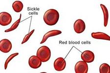 پیشرفت محققان در درمان کم خونی داسی شکل