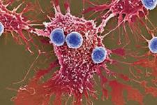 ایمنی درمانی مبتنی بر سلول های کشنده ذاتی(NK cells) موثر در برای انواع متعدد لوکمیا