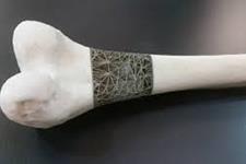 پرینت سه بعدی زنده داربست های استخوان زا درون نواقص استخوانی