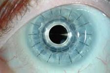 زیست پرینت سه بعدی: درمانی برای نابینایی قرنیه در آینده؟