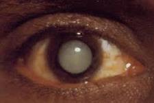 شناسایی مراحل تکوینی تومورهای چشم در کودکان