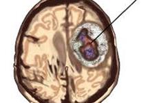شناسایی موتاسیون ژنی مرتبط با شکل تهاجمی تومورهای مغزی 