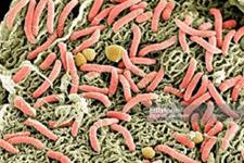 پیوند میکروبیوم مدفوع موثر در برابر کولیت ناشی از ایمنی درمانی