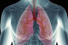 داروی سلول درمانی می تواند درمانی برای علایم COPD ناشی از سیگار باشد