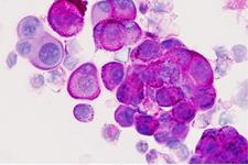 هدف قرار دادن سلول های بنیادی سرطانی مزوتلیوما
