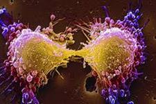 سلول های سرطانی تمایل دارند روی بافت سفت رشد کنند