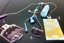 استفاده از سلول های بنیادی خون بند ناف برای کاهش خطر رد پیوند در بیمار چینی