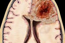 وضعیت متابولیکی سلول های بنیادی سرطان مغز به طور قابل ملاحظه ای با سلول های سرطانی که آن ها تولید می کنند متفاوت است