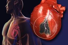 سلول های بنیادی و رمزگشایی از مشکلات قلبی وراثتی
