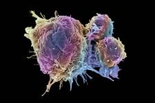 کشتن سلول های بنیادی سرطانی نامیرا