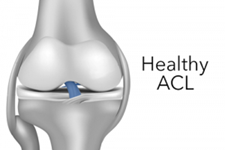 شناسایی یک رویکرد بازسازی کننده برای تقویت ACL