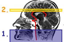 ابزاری برای شناسایی جریان خون مغزی که می تواند نشانه های اولیه زوال عقل و آلزایمر را نشان دهد