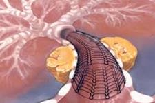 استفاده از سلول های بنیادی برای تمیز کردن شریان های مسدود شده
