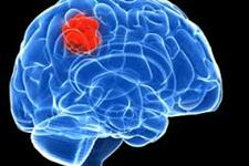 شبکه توموری در مغز مقاومت به درمان را افزایش می دهد