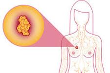 کشف تفاوت های ژنتیکی بین سرطان سینه عود کننده وغیرتهاجمی!