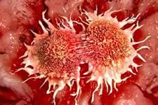 کمک گرفتن سلول های سرطانی از سلول های سالم برای متاستاز و مقاومت در برابر درمان