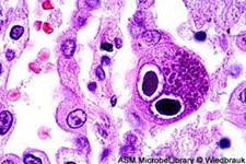  داروی ضد ویروسی Chimerix در عفونت های بعد از پیوند سلول های بنیادی موثر نیست
