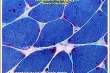 امیدوار کننده بودن ژن درمانی برای میوپاتی نمالین