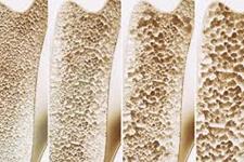 موافقت FDA با استفاده از نوعی پلیمر برای کمک به رشد مجدد استخوان