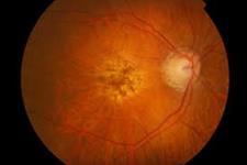 سلول های بنیادی بینایی را در جانوران مبتلا به تخریب شبکیه پیشرفته احیا می کنند