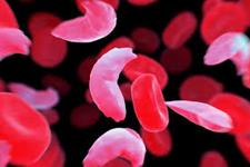 موفقیت آمیز بودن ژن درمانی های مبتنی بر BCL11A برای کم خونی داسی شکل در مطالعات پیش درمانگاهی