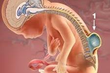 مقایسه استفاده از بند ناف در مقابل نوار بیوسلولزی برای ترمیم spina bifida‌ قبل از تولد