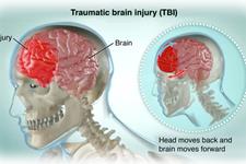 اثرات درمانی سلول های بنیادی در آسیب های مغزی