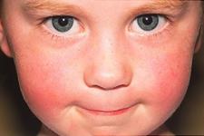 بیماری کرونا و سندرم التهابی چند سیستمی در کودکان